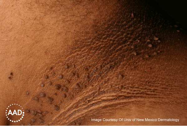 Acanthosis nigricans on Black skin